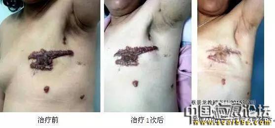 對(duì)于瘢痕疙瘩系統(tǒng)治療的新思路分享[tag]