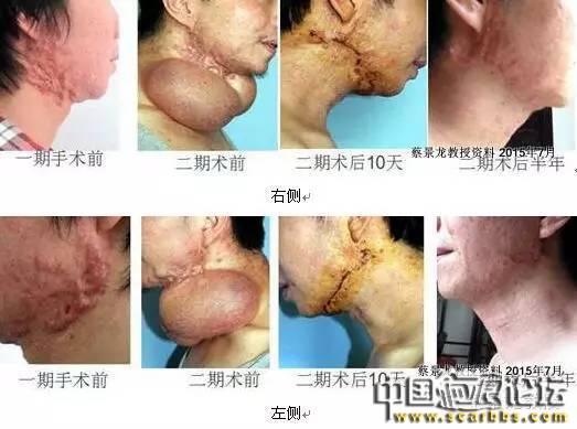 對(duì)于瘢痕疙瘩系統(tǒng)治療的新思路分享[tag]