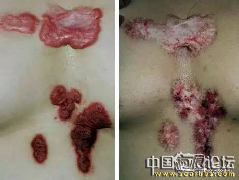 對(duì)于瘢痕疙瘩系統(tǒng)治療的新思路分享[tag]