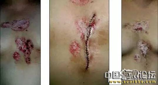 對(duì)于瘢痕疙瘩系統(tǒng)治療的新思路分享[tag]