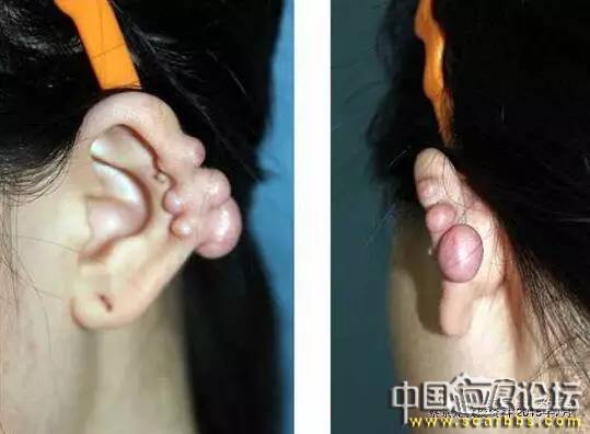 對(duì)于瘢痕疙瘩系統(tǒng)治療的新思路分享[tag]