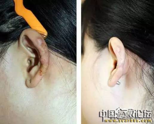 對(duì)于瘢痕疙瘩系統(tǒng)治療的新思路分享[tag]