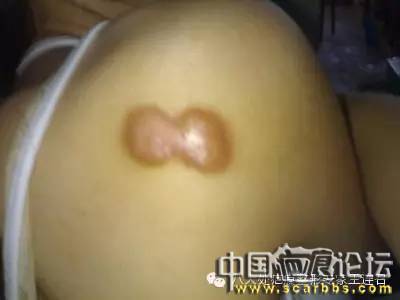 疤痕疙瘩手術(shù)治療的一些常見問題解決方法[tag]