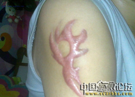 疤痕體質(zhì)容易與哪些什么疤痕種類與癥狀容易混淆？[tag]