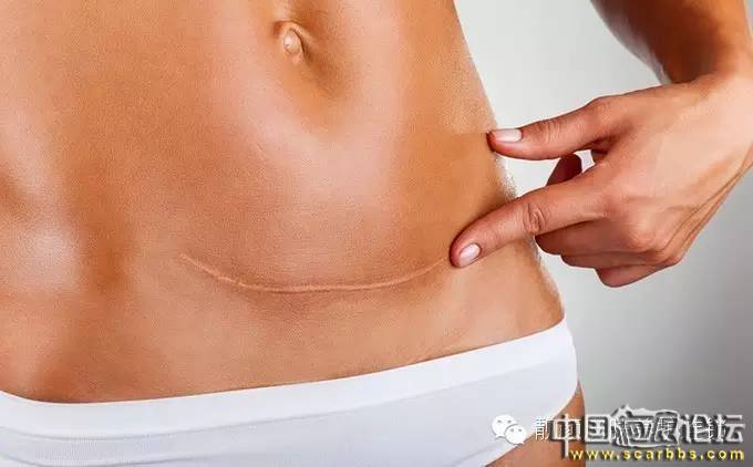 疤痕體質(zhì)容易與哪些什么疤痕種類與癥狀容易混淆？[tag]