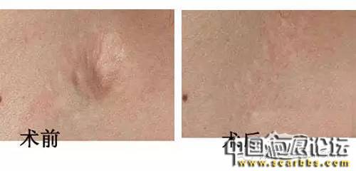 淺析凹陷疤痕的形成機(jī)理以及治療修復(fù)方法[tag]