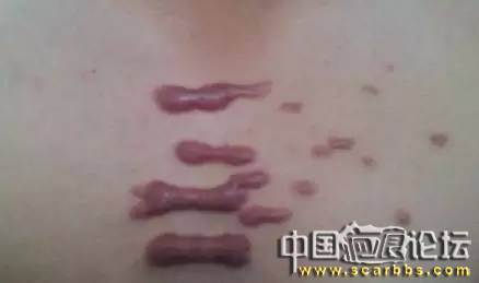 疤痕體質(zhì)的預(yù)防和治療的各種方法以及護理技巧分享[tag]