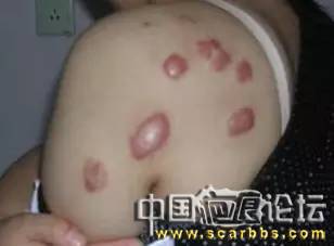 疤痕體質(zhì)的預(yù)防和治療的各種方法以及護理技巧分享[tag]