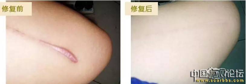 疤痕體質(zhì)的預(yù)防和治療的各種方法以及護理技巧分享[tag]