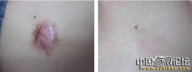 疤痕體質(zhì)的預(yù)防和治療的各種方法以及護理技巧分享[tag]