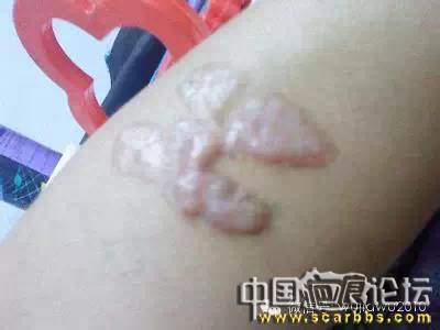 影響疤痕增生的主要因素分析[tag]