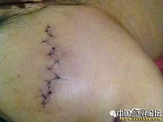 疤痕手術(shù)切縫的手術(shù)切口形狀設(shè)計(jì)問題介紹[tag]