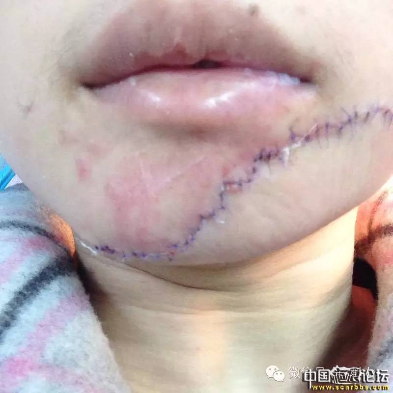 疤痕手術(shù)切縫的手術(shù)切口形狀設(shè)計(jì)問題介紹[tag]