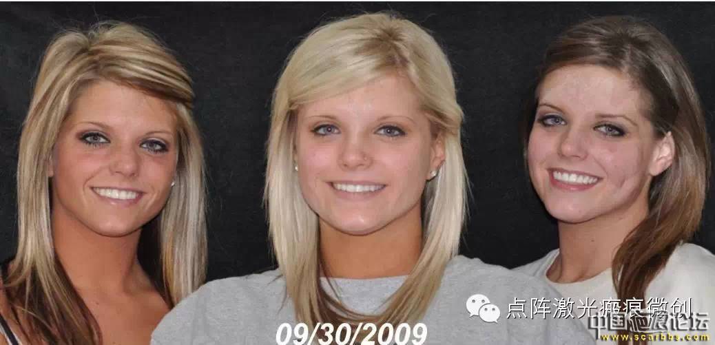 淺析疤痕常規(guī)治療方法之微創(chuàng)治療[tag]