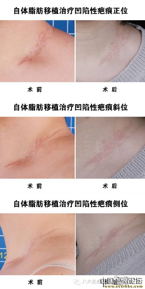 淺析自體脂肪移植對于瘢痕治療的效果[tag]