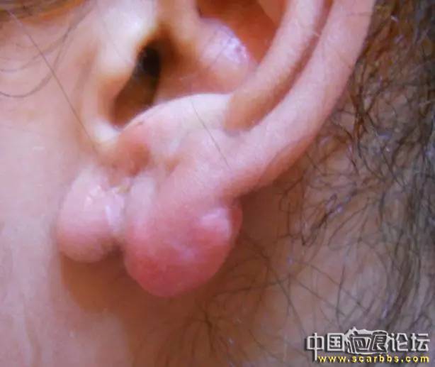 淺析通過肉毒素治療瘢痕疙瘩的方法[tag]