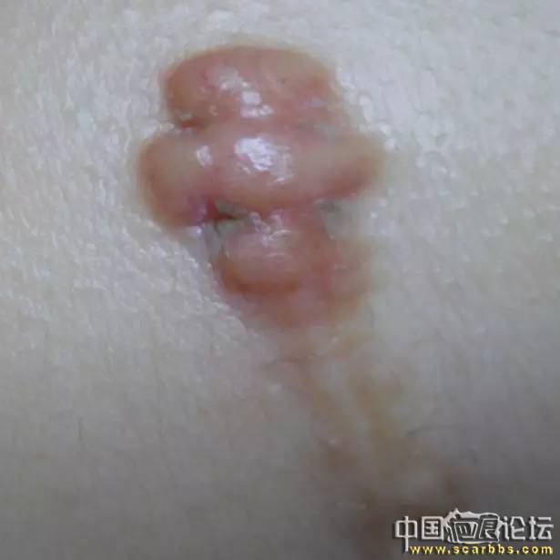 淺析通過肉毒素治療瘢痕疙瘩的方法[tag]