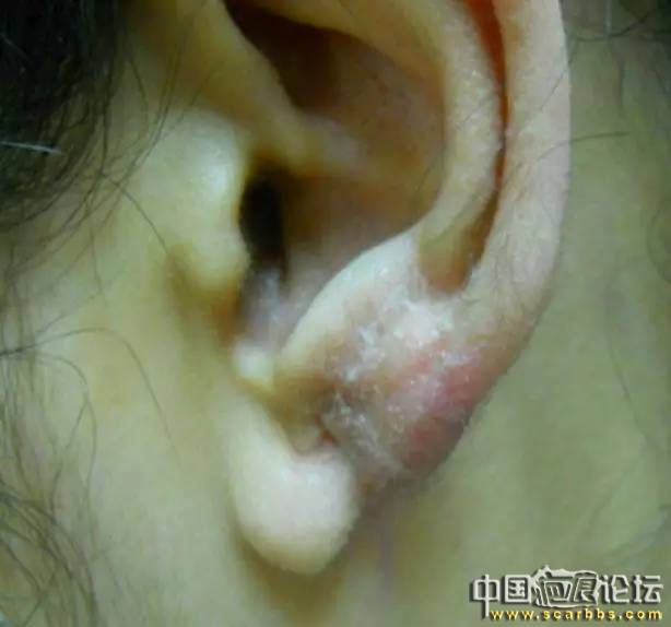 淺析通過肉毒素治療瘢痕疙瘩的方法[tag]