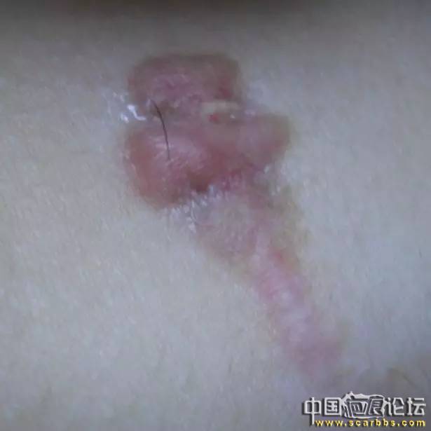 淺析通過肉毒素治療瘢痕疙瘩的方法[tag]