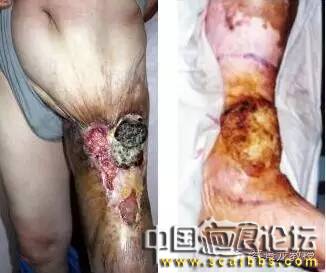 關于瘢痕癌的癥狀以及病史分析[tag]