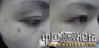 淺析疤痕治療修復(fù)方面的十個(gè)疤友們常問(wèn)的問(wèn)題[tag]