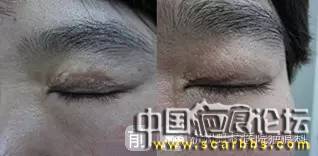 淺析疤痕治療修復(fù)方面的十個(gè)疤友們常問(wèn)的問(wèn)題[tag]