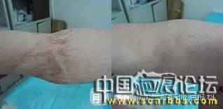 淺析疤痕治療修復(fù)方面的十個(gè)疤友們常問(wèn)的問(wèn)題[tag]