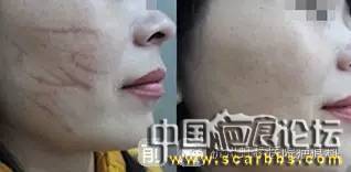 淺析疤痕治療修復(fù)方面的十個(gè)疤友們常問(wèn)的問(wèn)題[tag]