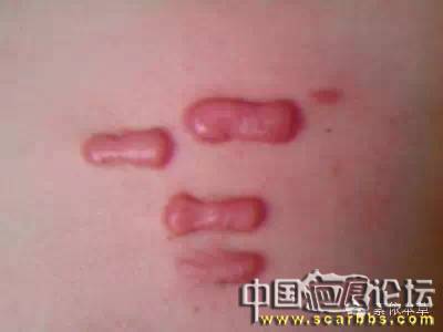 疤痕疙瘩對(duì)疤痕患者造成的傷害是很大的[tag]