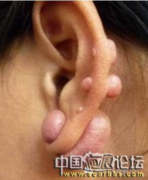 淺析治療耳部疤痕疙瘩的疤痕內(nèi)核切除術(shù)[tag]