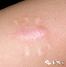 疤痕相關(guān)基礎(chǔ)知識之疤痕的具體分類介紹[tag]