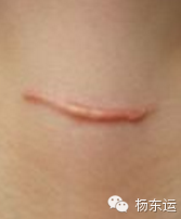 疤痕相關(guān)基礎(chǔ)知識之疤痕的具體分類介紹[tag]