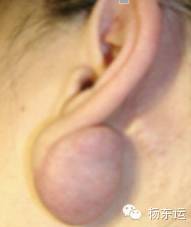 疤痕相關(guān)基礎(chǔ)知識之疤痕的具體分類介紹[tag]