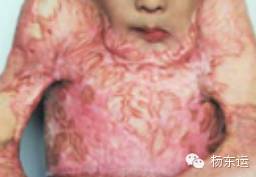 疤痕相關(guān)基礎(chǔ)知識之疤痕的具體分類介紹[tag]