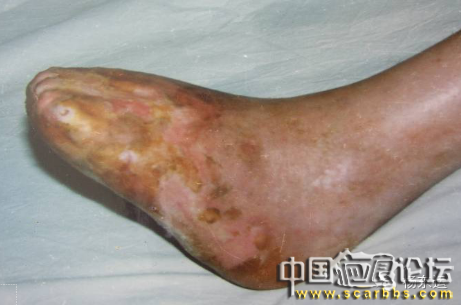 疤痕相關(guān)基礎(chǔ)知識之疤痕的具體分類介紹[tag]