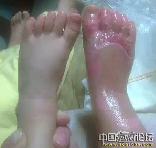 燙傷止疼預防留疤痕的偏方分享[tag]