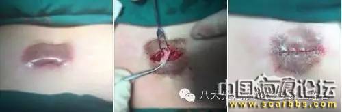 詳解瘢痕疙瘩的治療方法[tag]