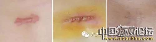 詳解瘢痕疙瘩的治療方法[tag]