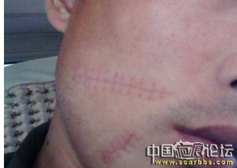 藥物抗疤的藥物以及產(chǎn)品的具體使用方法[tag]