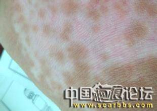 疤痕色素缺失的原因及治療[tag]