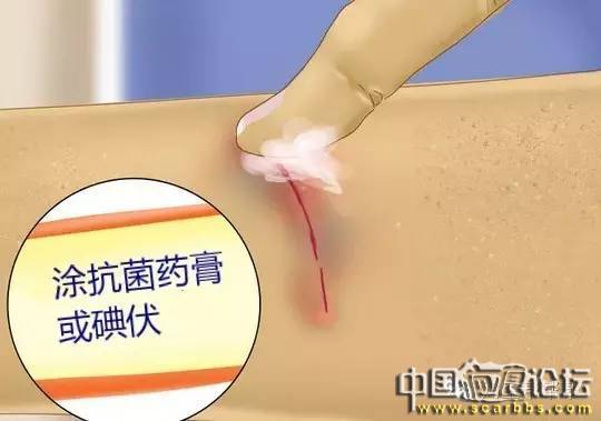 兒童摔傷、擦傷疤痕如何正確處理才能避免留疤？[tag]