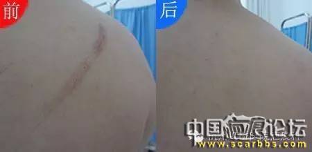 兒童摔傷、擦傷疤痕如何正確處理才能避免留疤？[tag]