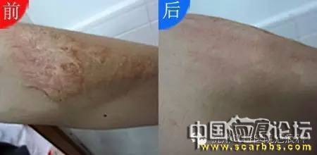 兒童摔傷、擦傷疤痕如何正確處理才能避免留疤？[tag]