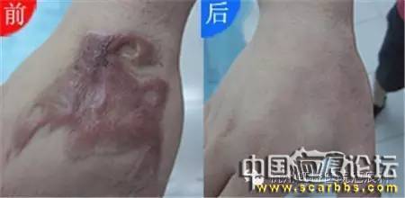 兒童摔傷、擦傷疤痕如何正確處理才能避免留疤？[tag]