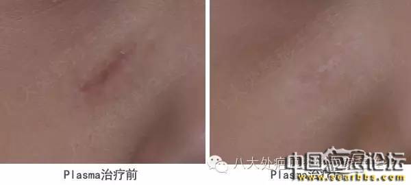 Plasma治療疤痕的原理以及治療效果[tag]