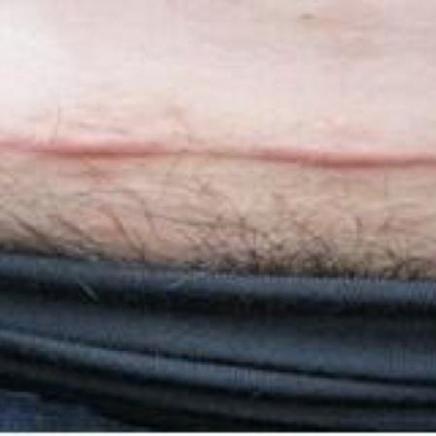 燒傷后足疤痕修復(fù)怎么做？[tag]