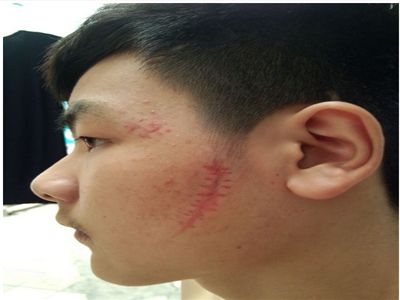 剖腹疤痕護理誤區(qū)解析[tag]