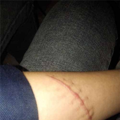 剖腹疤痕護理誤區(qū)解析[tag]