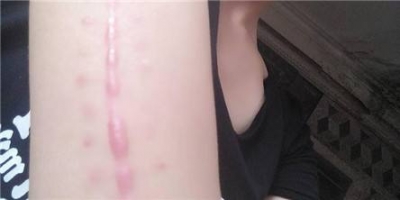疤痕手術(shù)又哪些注意事項呢？[tag]