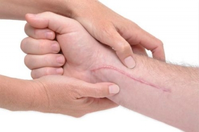 燒傷疤痕疙瘩概述[tag]